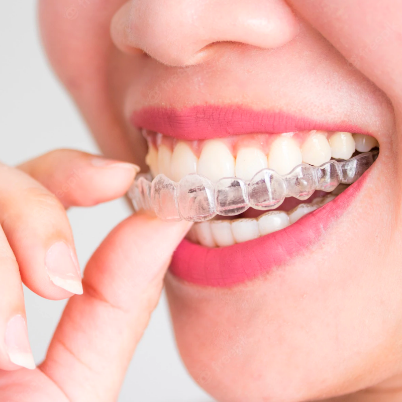 invisalign braces